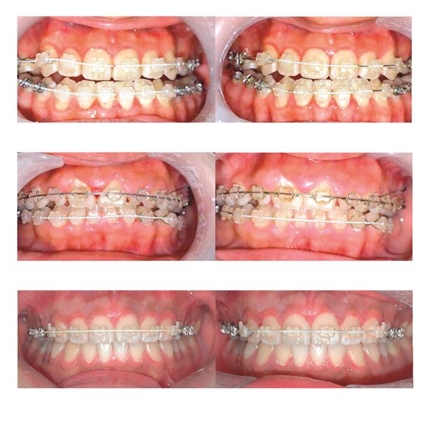 Euroform +Cosmetic NiTi Therm.D guľaté .016  10 ks
