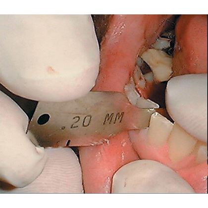 Interproximálne mierky set 6 ks