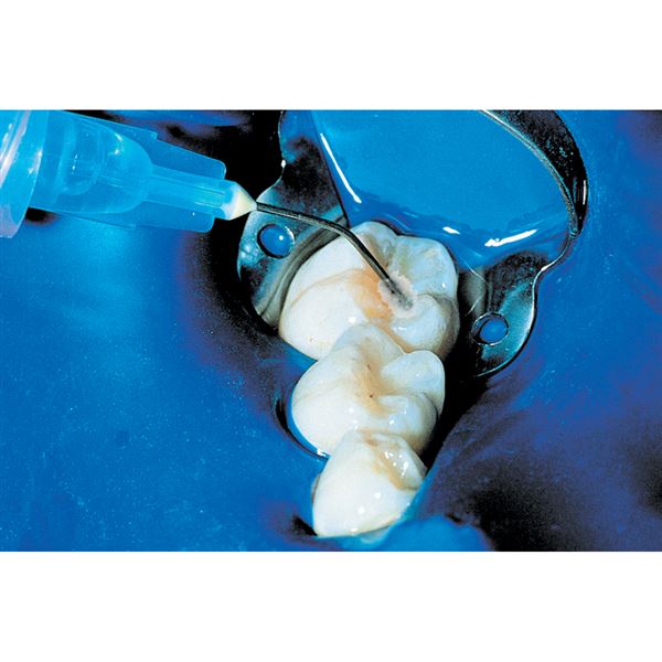 UltraSeal XT Plus op. biela 20 x 1,2 ml