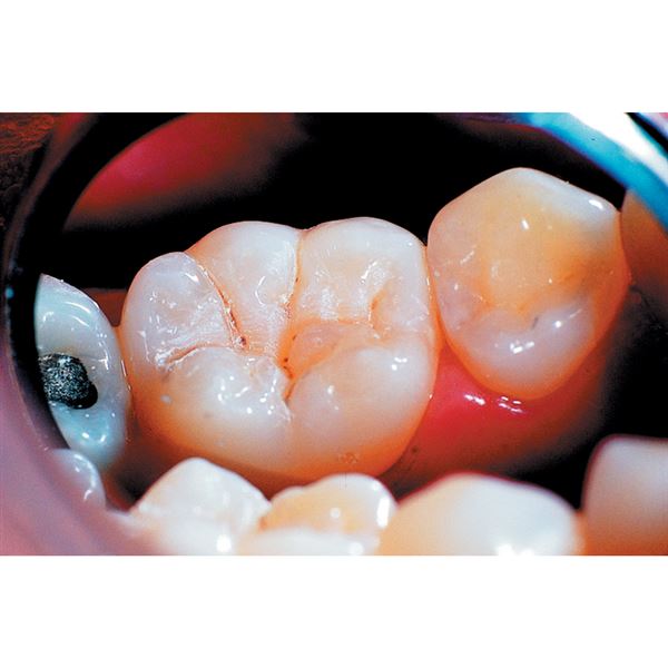 UltraSeal XT Plus op. biela 20 x 1,2 ml