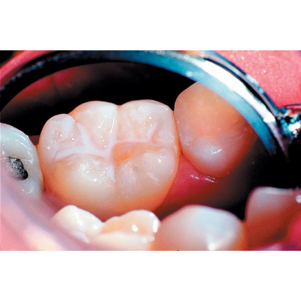UltraSeal XT Plus op. biela 20 x 1,2 ml