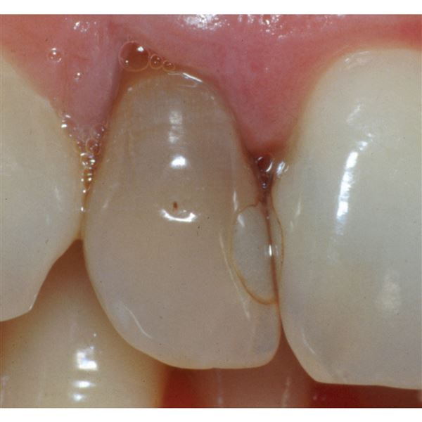Opalescence Endo 2 x 1,2 ml