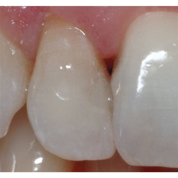 Opalescence Endo 2 x 1,2 ml
