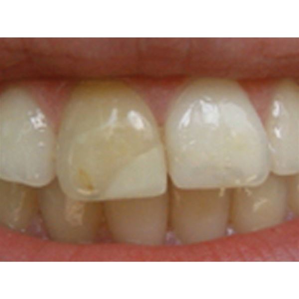 Opalescence Endo 2 x 1,2 ml