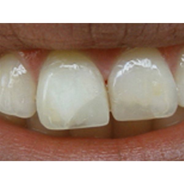 Opalescence Endo 2 x 1,2 ml