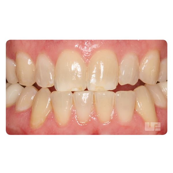 Opalescence  Boost 40% PF Pacienti kit/2x+prís.+kanyl10ks/