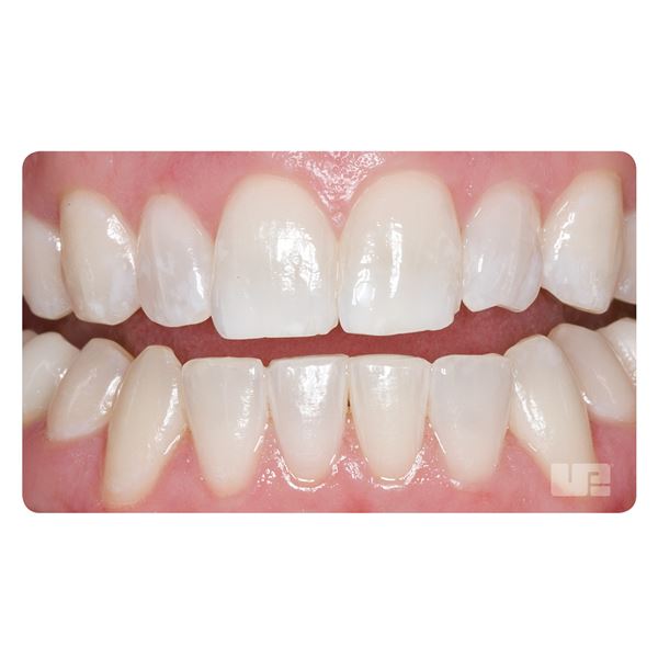 Opalescence  Boost 40% PF 20x1,2ml