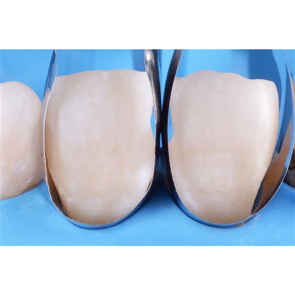 Unica Anetrior intro kit
