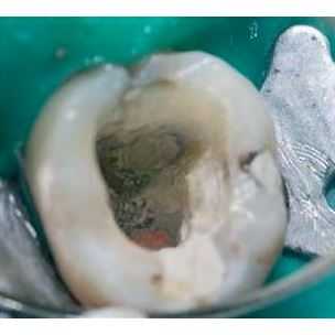 Biodentine 5 x 0,7g 
