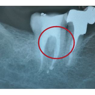 Biodentine 5 x 0,7g 