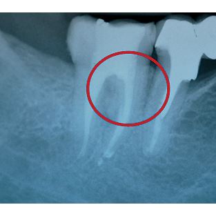 Biodentine 5 x 0,7g 
