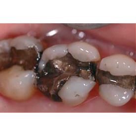 Biodentine 5 x 0,7g 