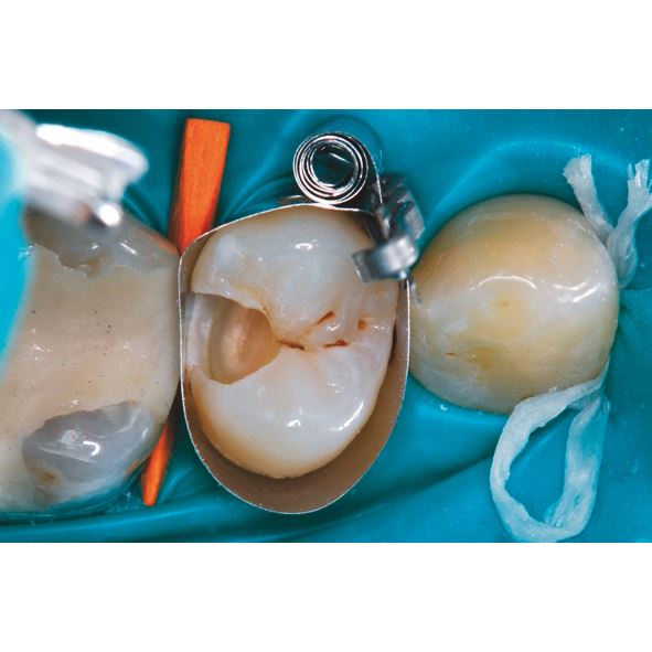 Biodentine 5 x 0,7g 
