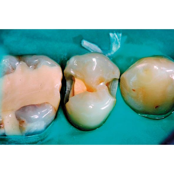 Biodentine 5 x 0,7g 