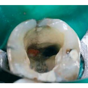 Biodentine 5 x 0,7g 