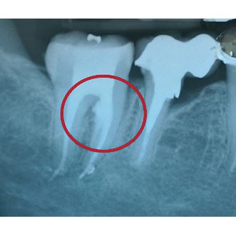 Biodentine 5 x 0,7g 