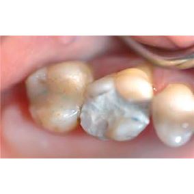 Biodentine 5 x 0,7g 