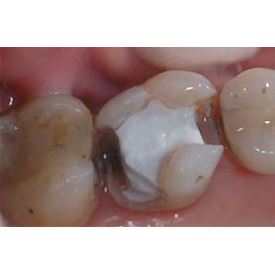 Biodentine 5 x 0,7g 