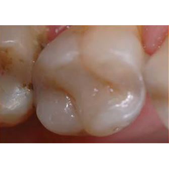 Biodentine 5 x 0,7g 