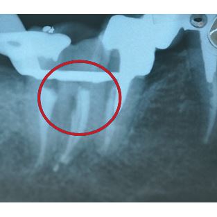 Biodentine 5 x 0,7g 