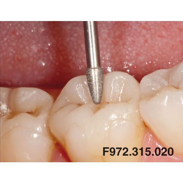 Occlusal Shaper ED F972.315.020 červené