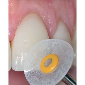Optidisc  general kit 9,6mm a 12,6mm - 240ks  No.:4200