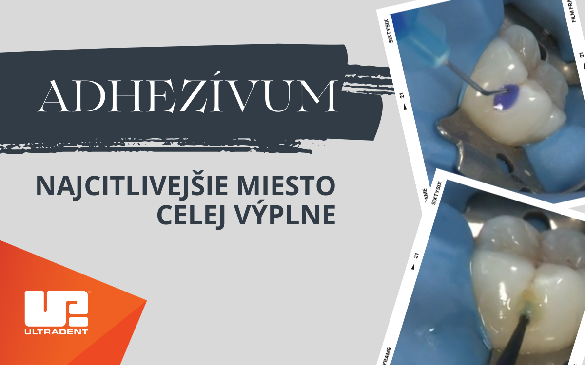 Perfektný bonding, na ktorý sa môžete spoľahnúť