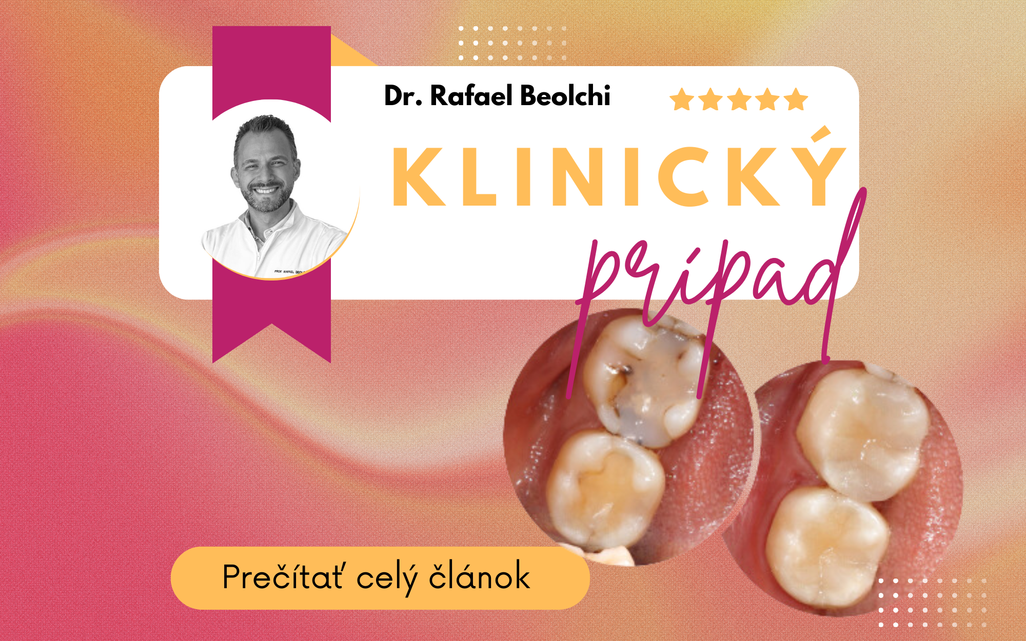 Klinický prípad - nevyhovujúce kompozitné náhrady na zuboch #36 a #37