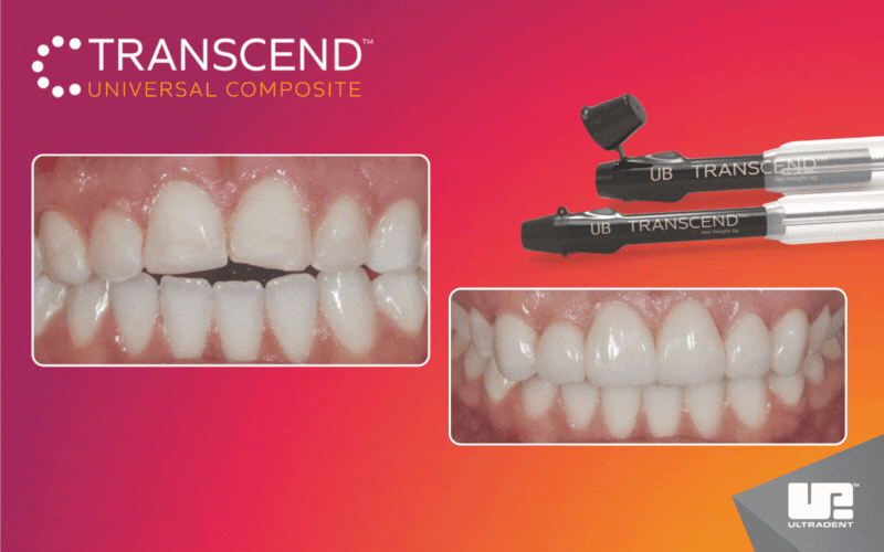 Klinický protokol pre kompozitné fazety bez preparácie